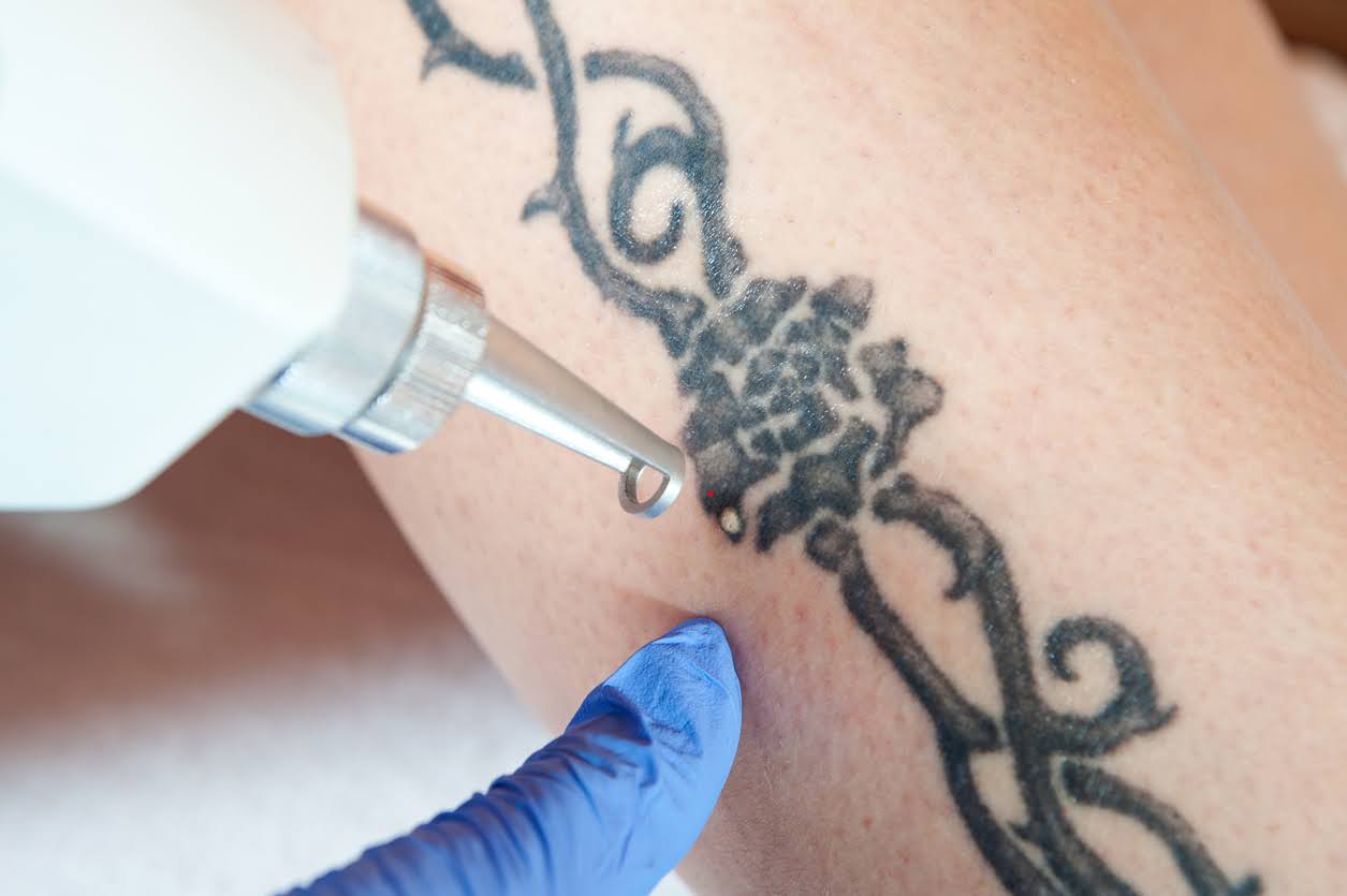 A trained laser technician guides a laser tattoo removal wand over a rose-and-thorns print