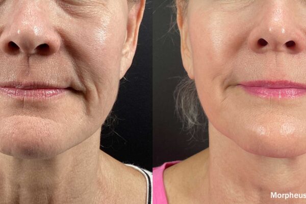 Before And After Morpheus8 Treatment Showing Tightened Jawline And Smooth Perioral Area
