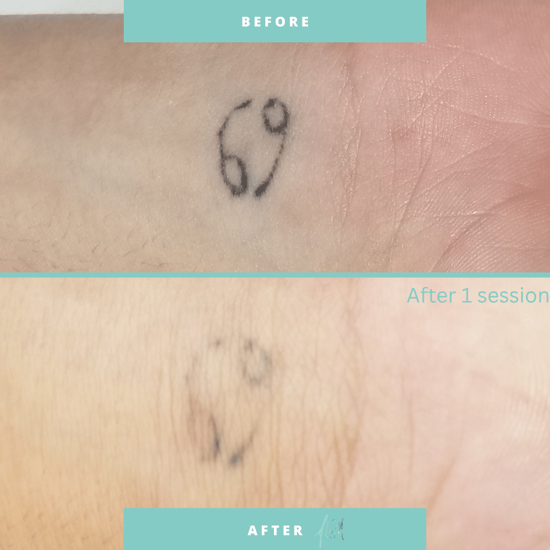 An image of a before and after tattoo removal